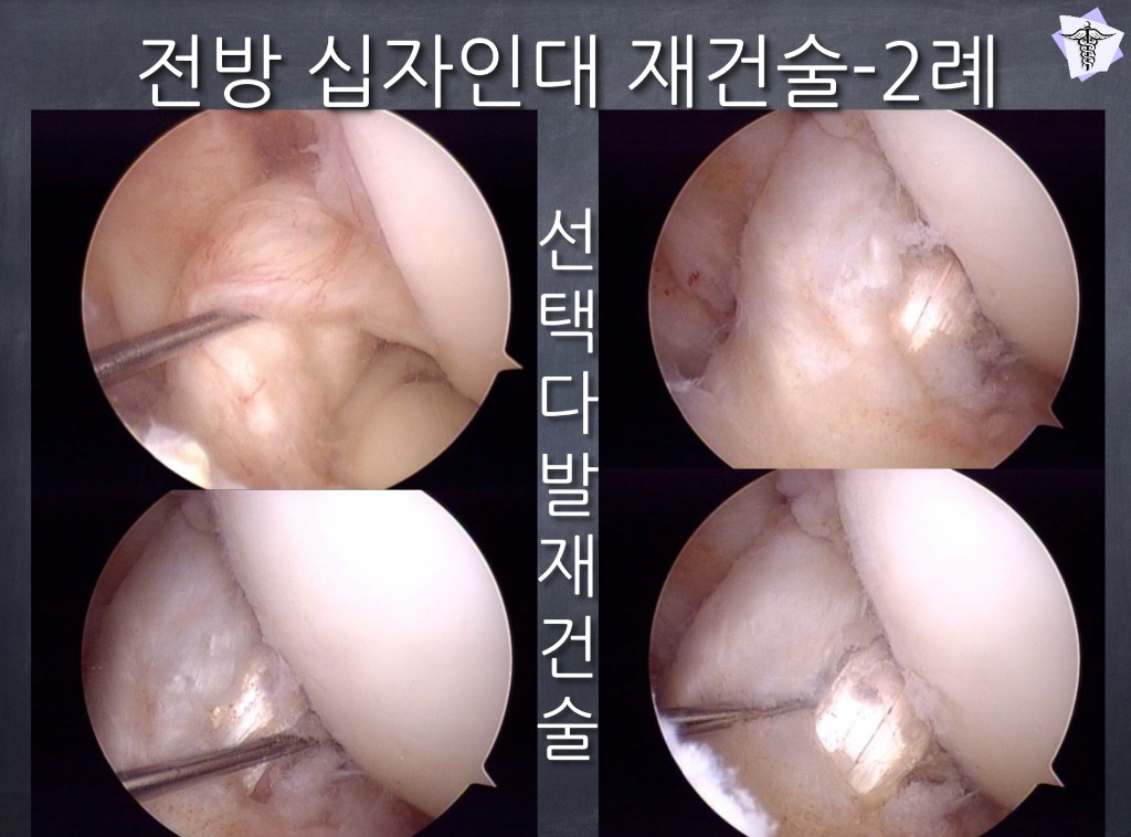 [센터장 브리핑] 무릎 전방 십자인대 재건술 환자 맞춤형 가이드 썸네일