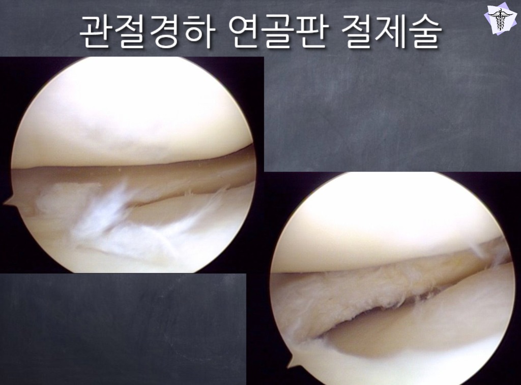 [센터장 브리핑] 연골판 절제술 2주 차 이후 필수 재활 스케줄 가이드 (2단계) 썸네일