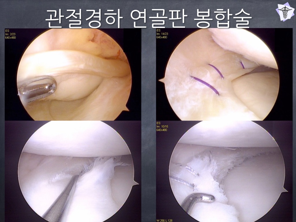 [센터장 브리핑] 반월상 연골판 봉합술 환자 맞춤형 재활 가이드 썸네일