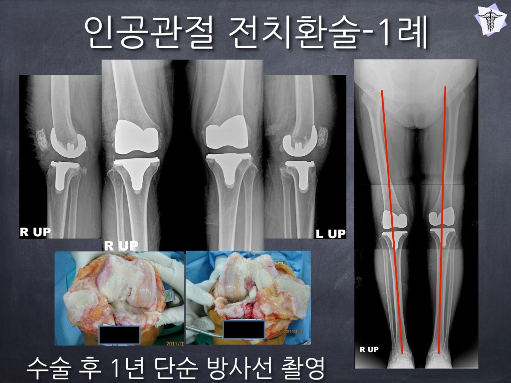 [센터장 브리핑] 무릎 인공관절 전치환술(TKA) 환자 맞춤형 재활 가이드 썸네일