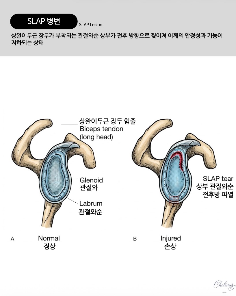 상관절와순 파열 해부도